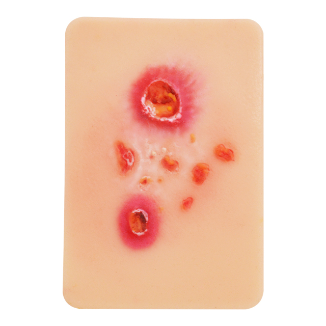 Bacterial Infection Display Cards(4 Types)