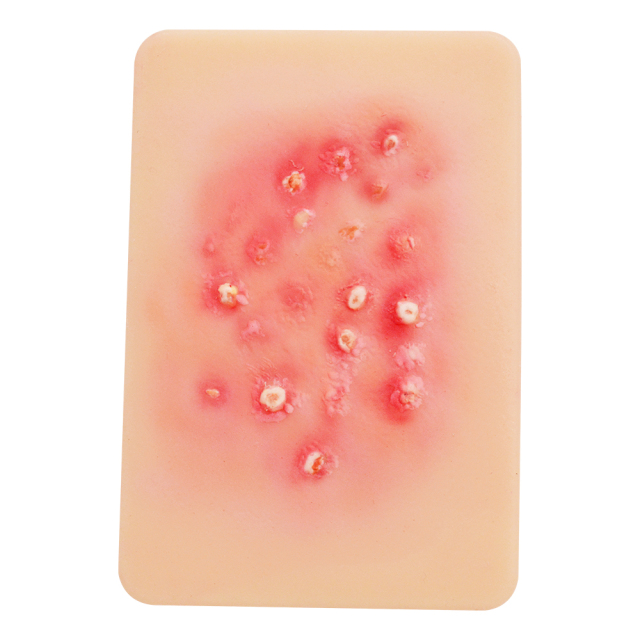 Bacterial Infection Display Cards(4 Types)