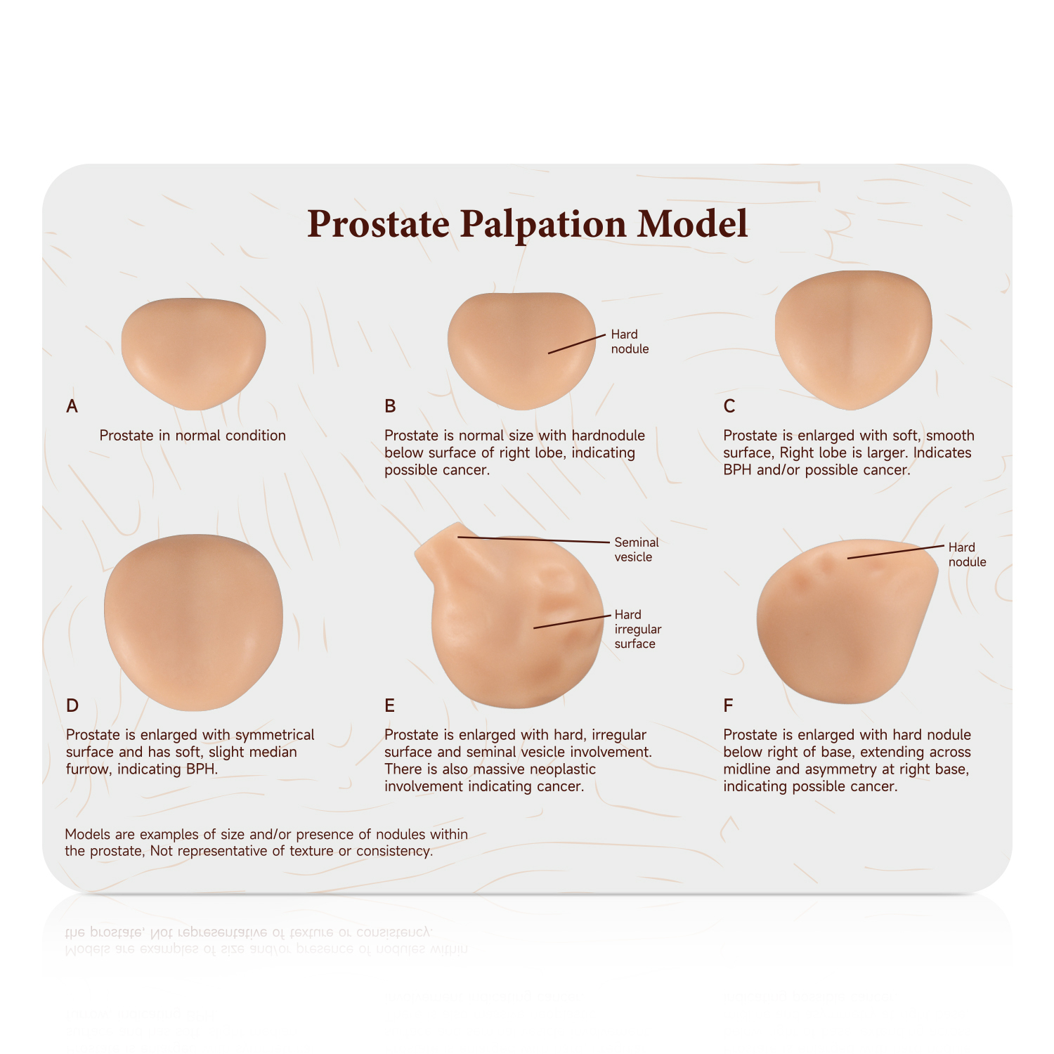 Prostate Palpation Education Model