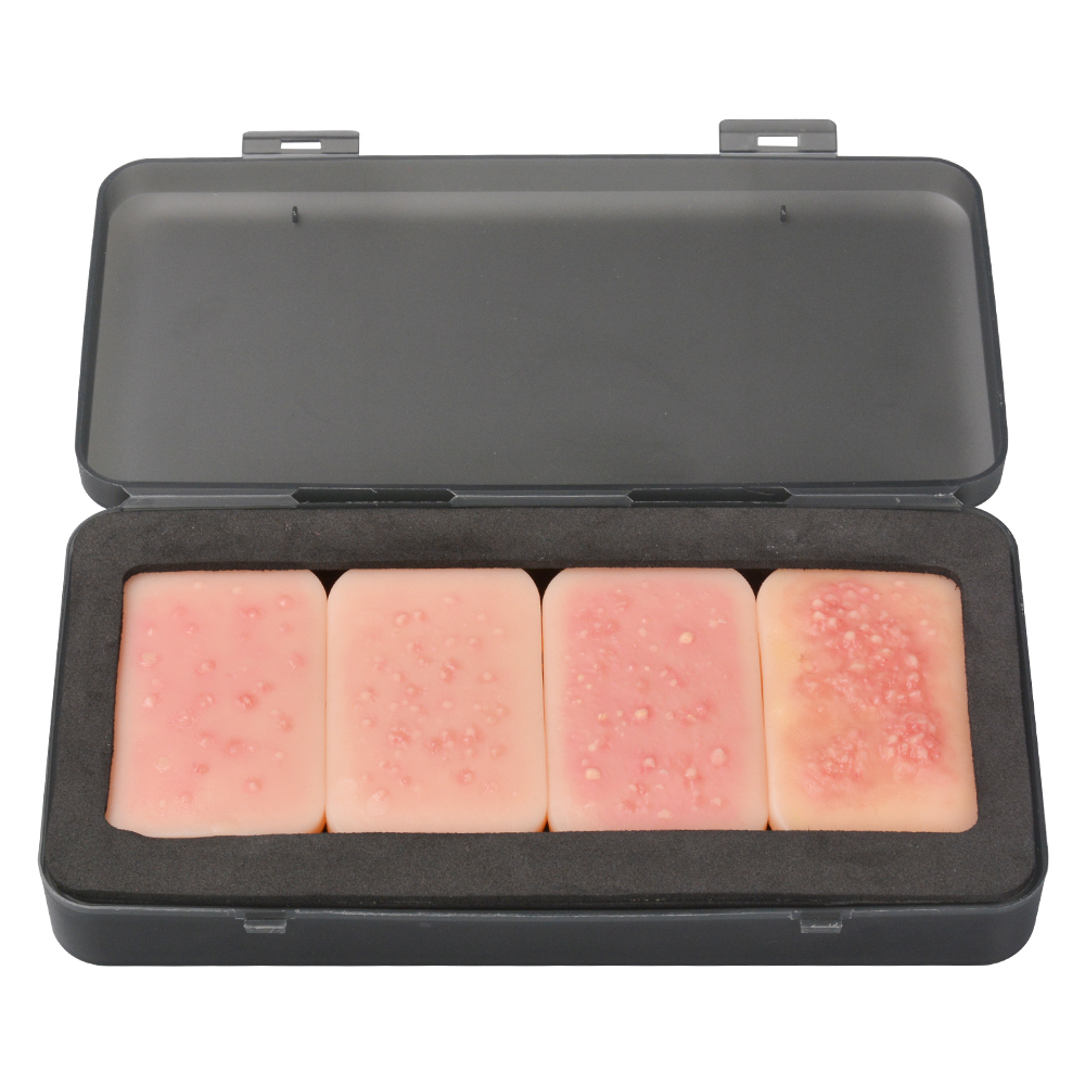 4-Stage Silicone Facial Acne Display Model