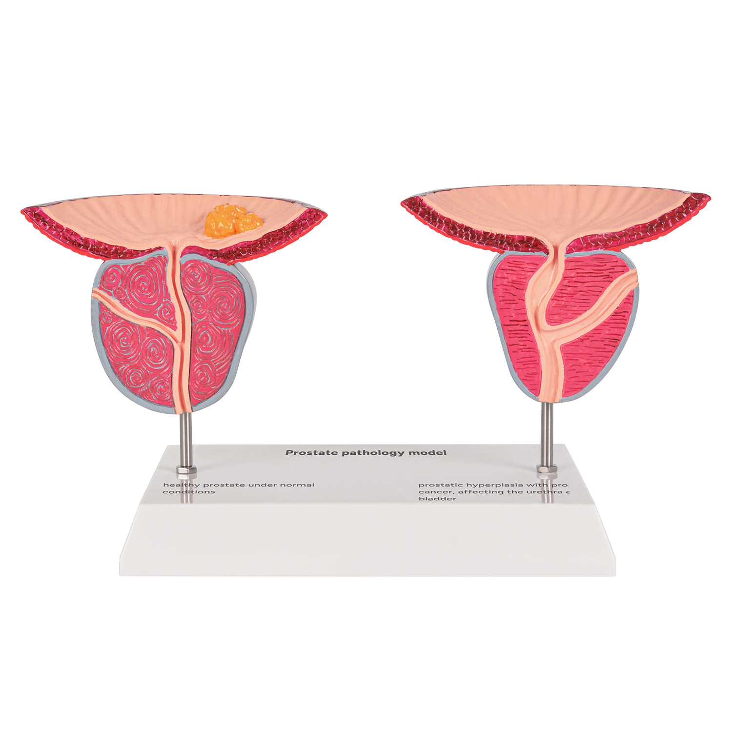 Prostate Pathology Model