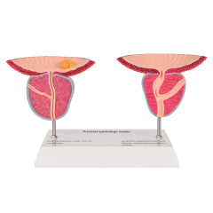 Prostate Pathology Model