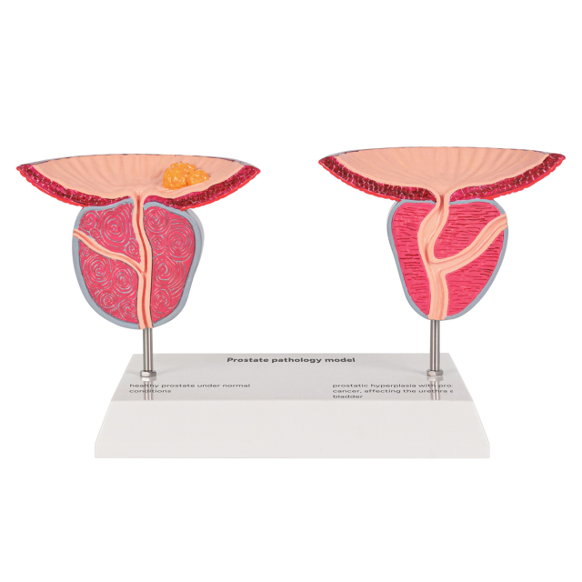 Prostate Pathology Model