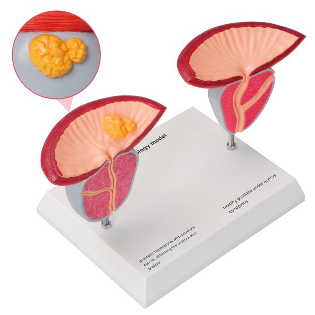 Prostate Pathology Model