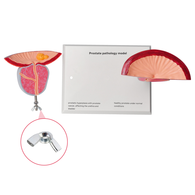 Prostate Pathology Model