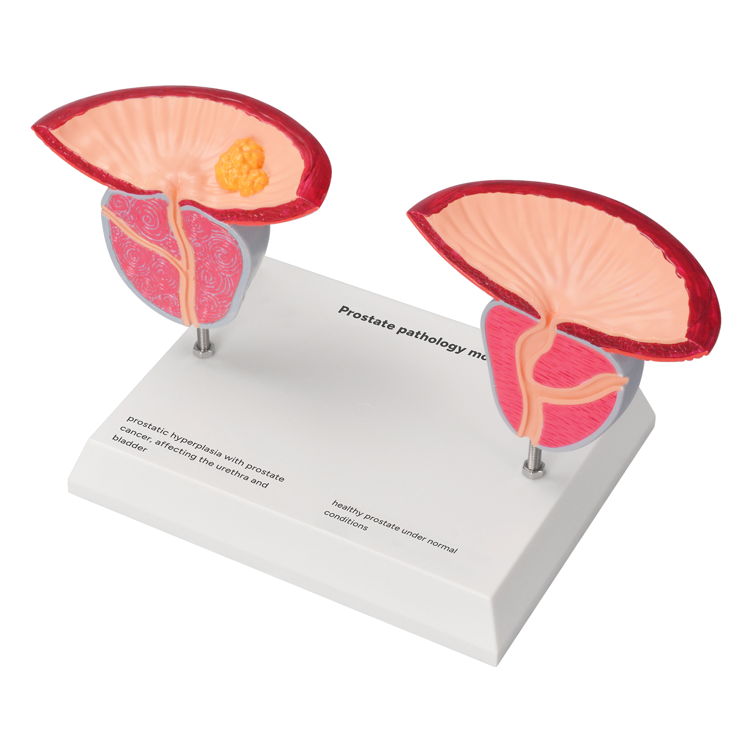 Prostate Pathology Model