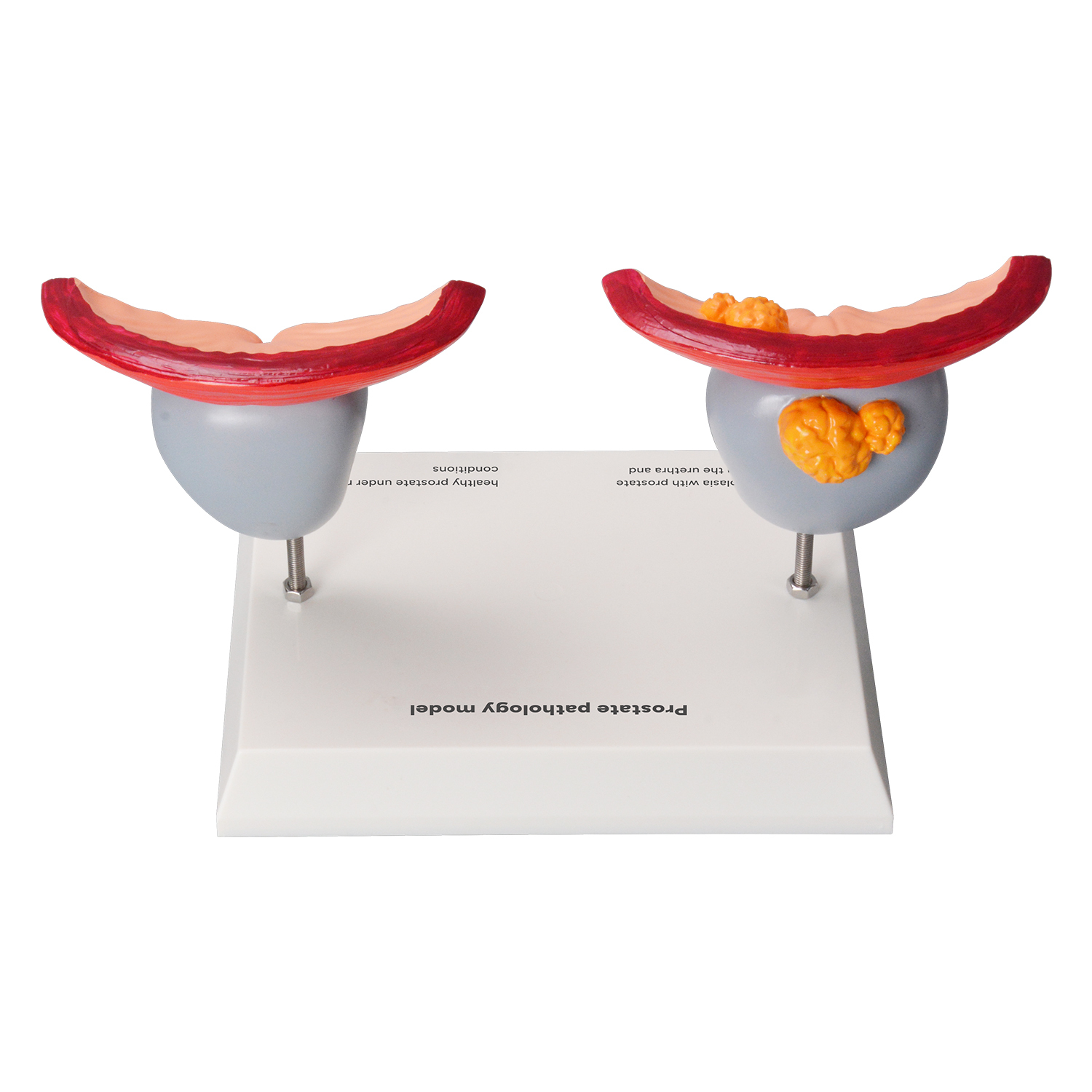 Prostate Pathology Model