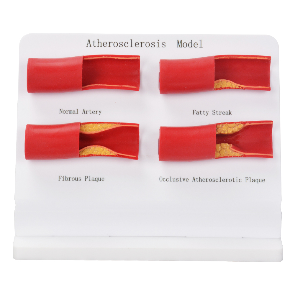 Atherosclerosis Anatomical Model