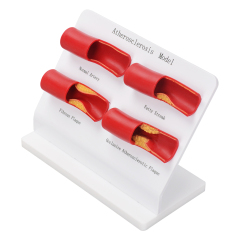 Atherosclerosis Anatomical Model
