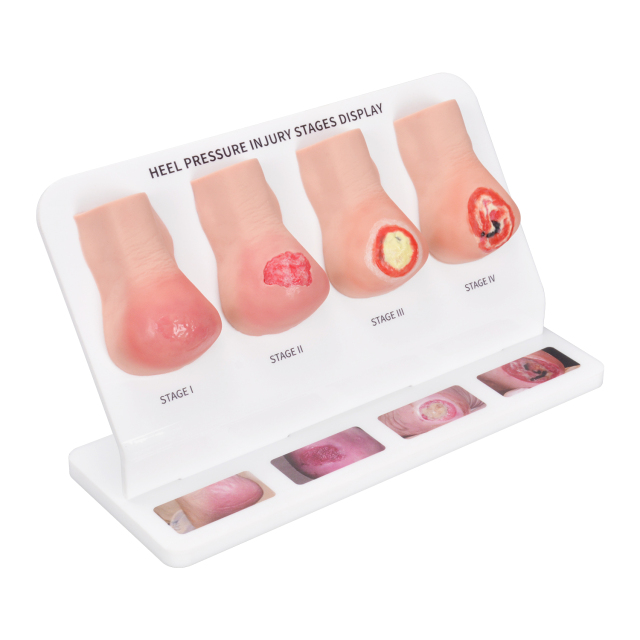 Heel Pressure Injury Stages Display Model