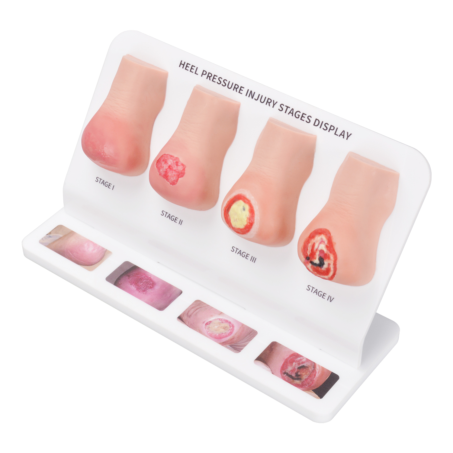 Heel Pressure Injury Stages Display Model