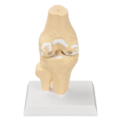 Arthritis Joint Model