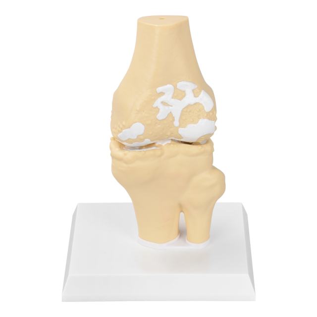Arthritis Joint Model