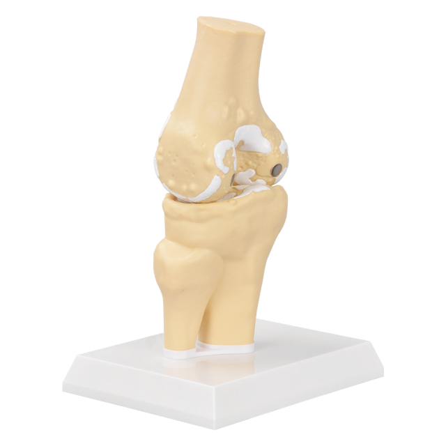Arthritis Joint Model
