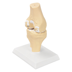 Arthritis Joint Model