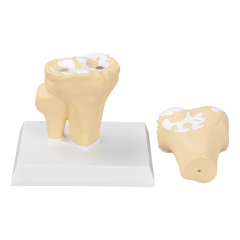 Arthritis Joint Model