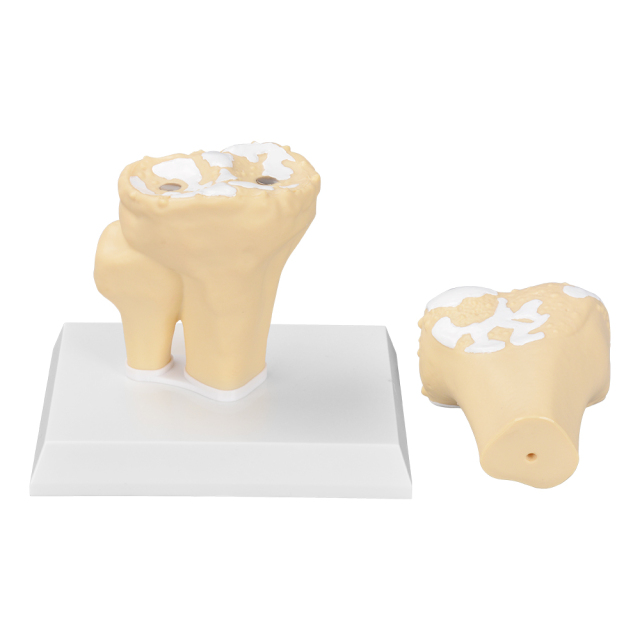 Arthritis Joint Model