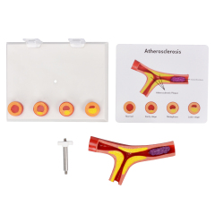 4-Part Arteriosclerosis Anatomical Model with Artery Cross Section