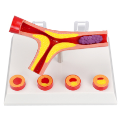 4-Part Arteriosclerosis Anatomical Model with Artery Cross Section