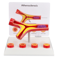 4-Part Arteriosclerosis Anatomical Model with Artery Cross Section