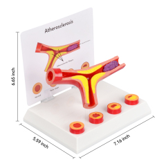 4-Part Arteriosclerosis Anatomical Model with Artery Cross Section