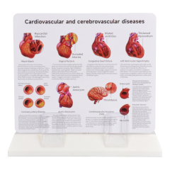 4-Part Arteriosclerosis Anatomical Model with Artery Cross Section
