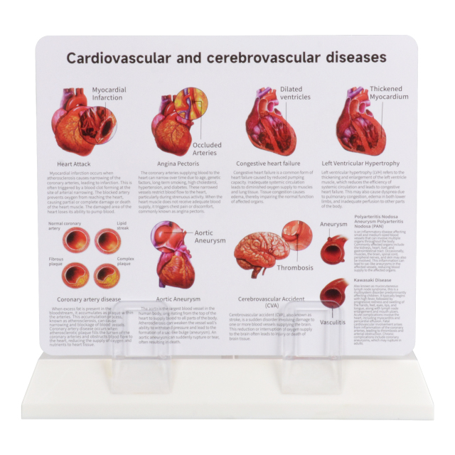 4-Part Arteriosclerosis Anatomical Model with Artery Cross Section