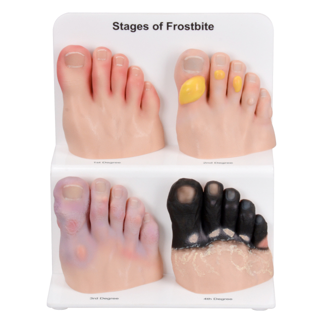 Frostbite Toe Staging Model for Clinical Teaching and Demonstration