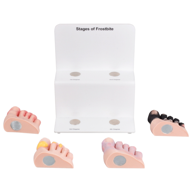 Frostbite Toe Staging Model for Clinical Teaching and Demonstration