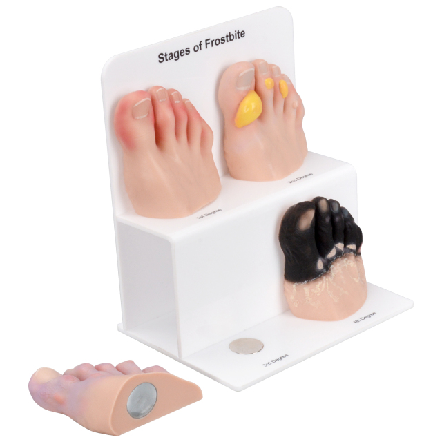 Frostbite Toe Staging Model for Clinical Teaching and Demonstration