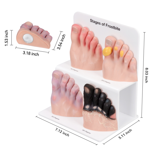 Frostbite Toe Staging Model for Clinical Teaching and Demonstration