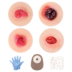 Sticky Unhealthy Stoma Simulation Models for Ostomy Care Training