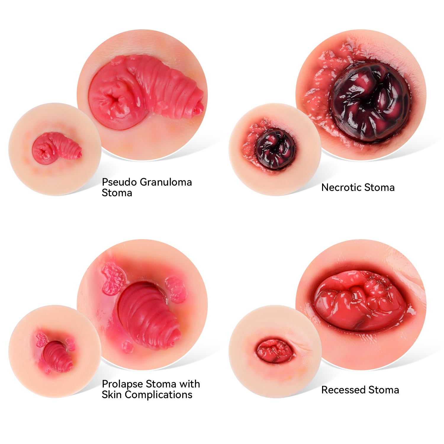Sticky Unhealthy Stoma Simulation Models for Ostomy Care Training