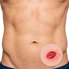 Sticky Unhealthy Stoma Simulation Models for Ostomy Care Training