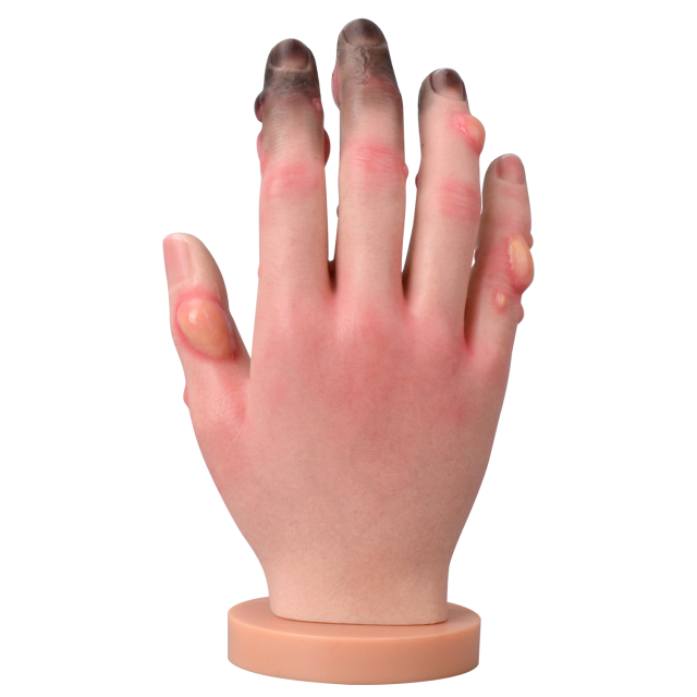 Grade 1-4 Hand Frostbite Simulation Model