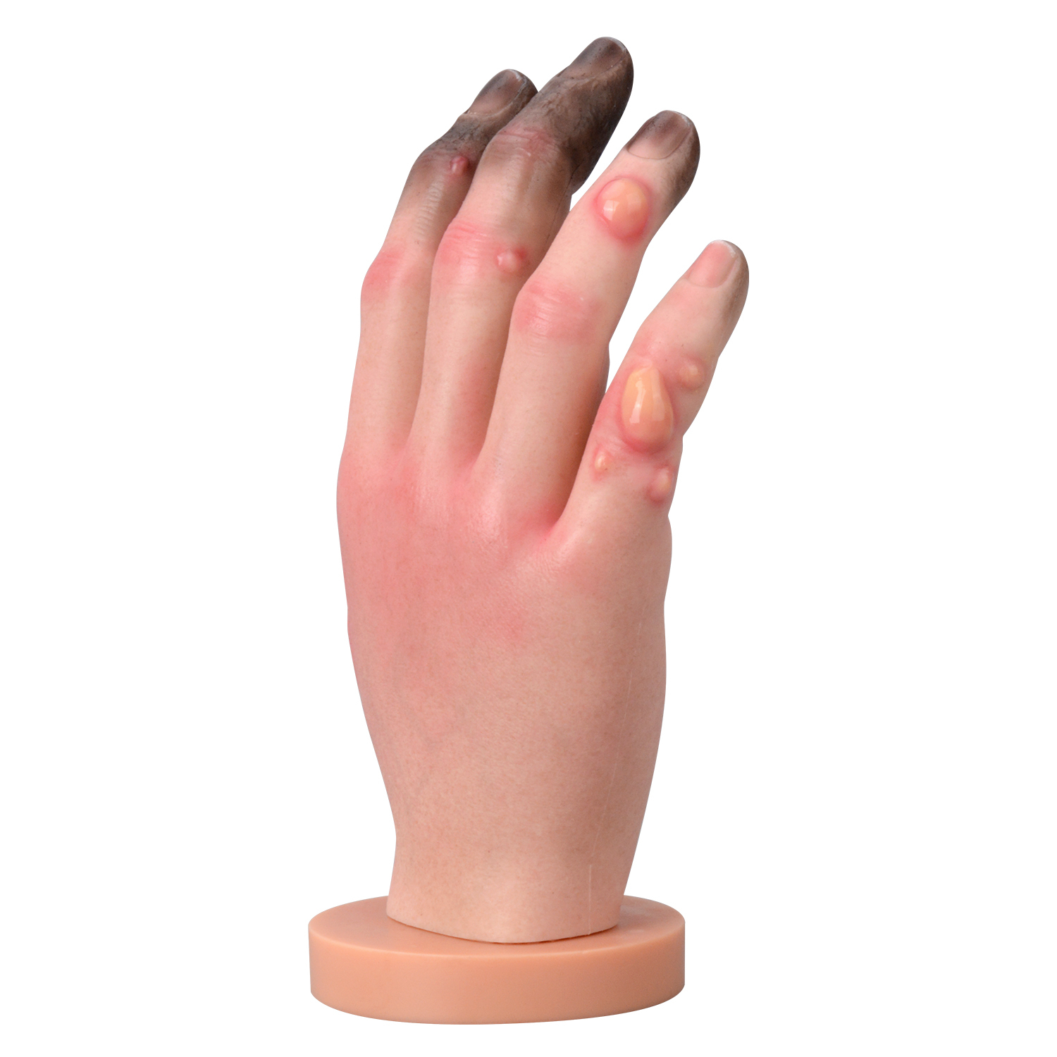 Grade 1-4 Hand Frostbite Simulation Model
