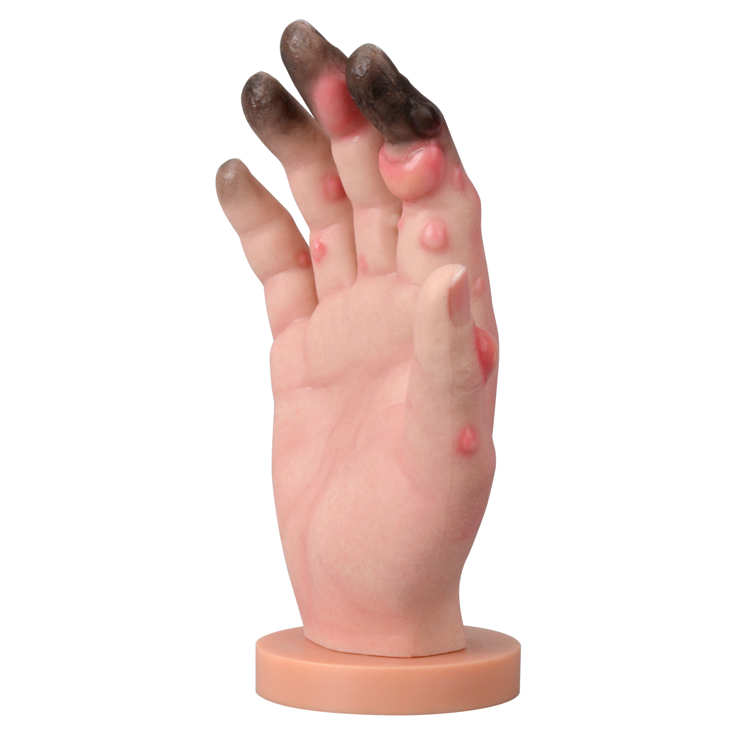 Grade 1-4 Hand Frostbite Simulation Model