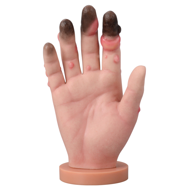 Grade 1-4 Hand Frostbite Simulation Model