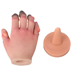 Grade 1-4 Hand Frostbite Simulation Model