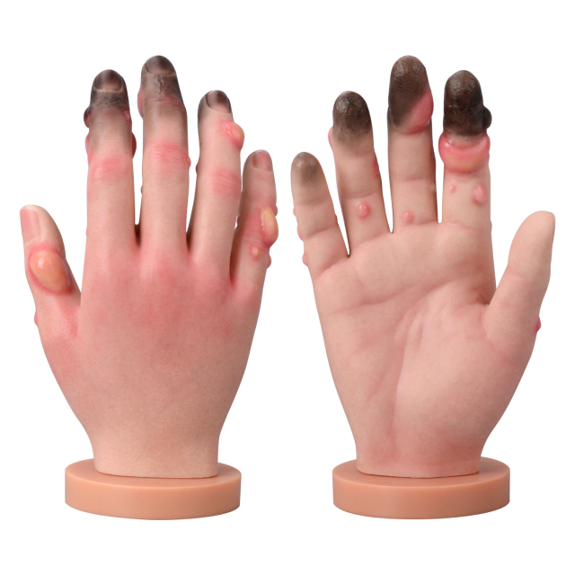 Grade 1-4 Hand Frostbite Simulation Model
