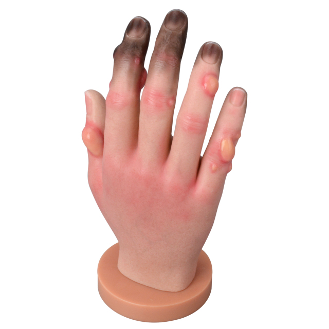 Grade 1-4 Hand Frostbite Simulation Model