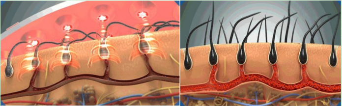red light therapy for hair growth