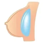 Jelly breasts