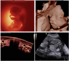 Medical Ultrasound Instruments Mindray Z50 Portable Color Doppler 3D 4D Ultrasound System Scanner Digital Ultrasound