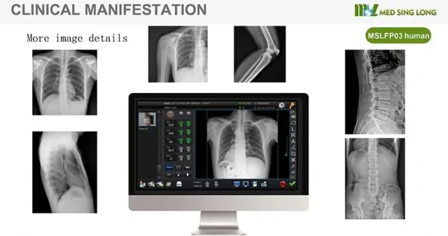 Best Iray Mars 1417V X Ray Medical Digital Dr Wireless Digital Flat Panel Detector for Hospital