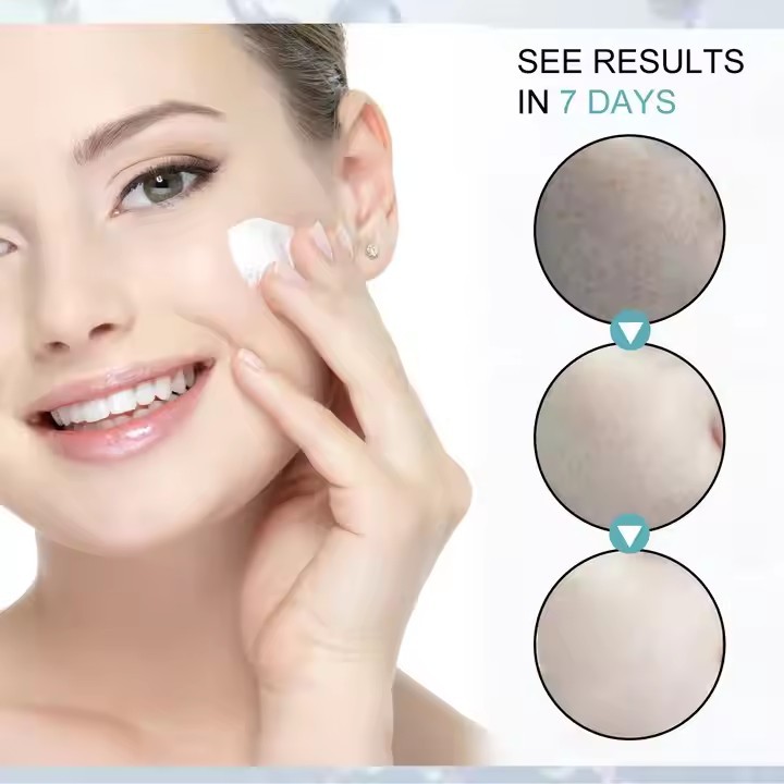 Facial skin cream Black freckles and acne faded black spots removal whitening cream