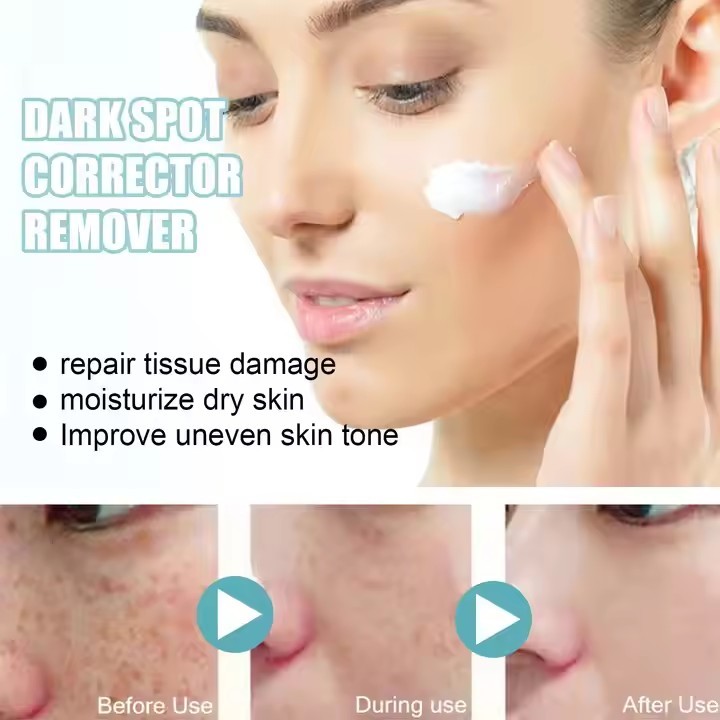 Facial skin cream Black freckles and acne faded black spots removal whitening cream