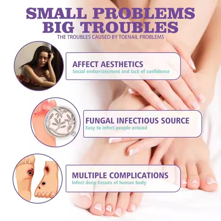 Jaysuing Onychomycosis Care Spray