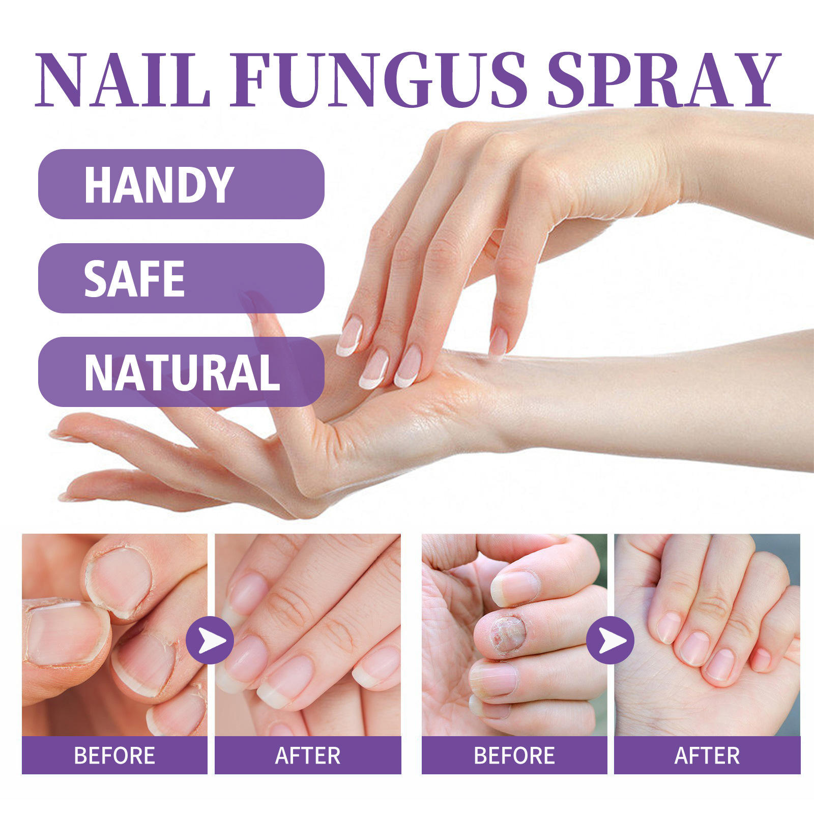 Jaysuing Onychomycosis Care Spray