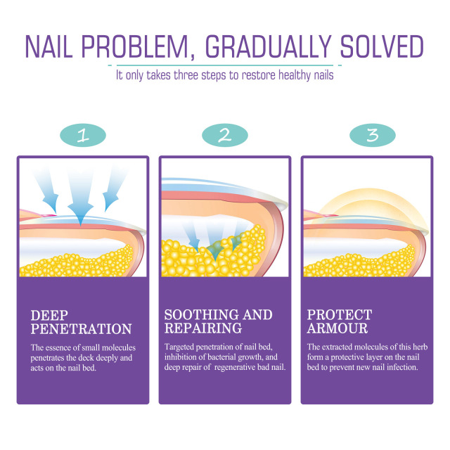 Jaysuing Onychomycosis Care Spray